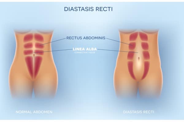 What Non-Surgical Options Are Available for Diastasis Recti Islington?