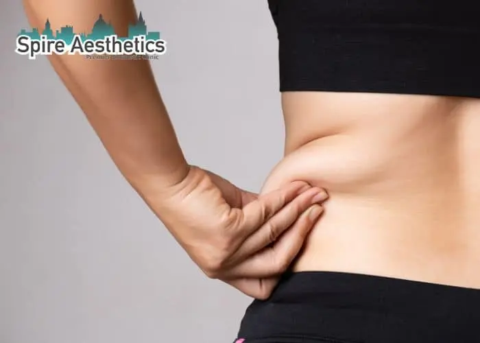Image of woman pinching fat on their hips Islington. Fat Freezing treatment