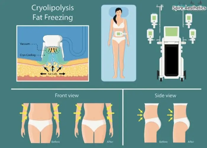 Fat freezing treatment Islington benefits for competitions to remove stubborn fat deposits.