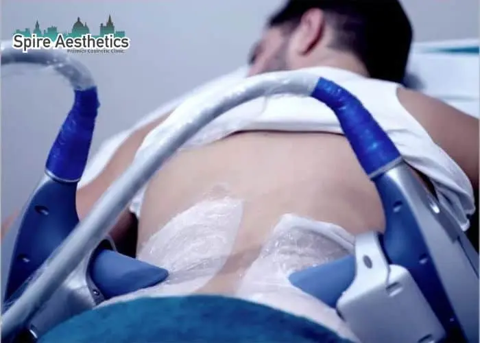 Man having fat freezing treatment done on love handles before a competitions Islington to create a sculpted look.