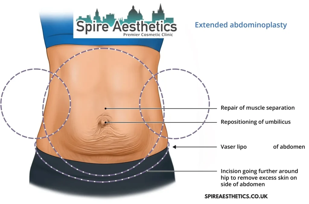 Understanding Loose Skin After Gastric Band Islington Surgery and HIFU Treatment