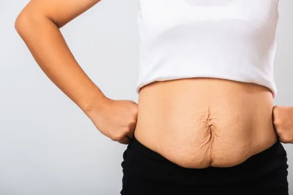 Image of a woman's stomach after weight loss with sagging skin following a gastric band Islington