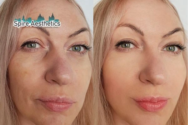 Morpheus8 Treatment Islington Before & After Results