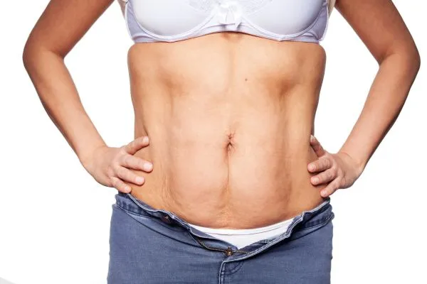 sagging skin on woman's stomach after weight loss injections Islington