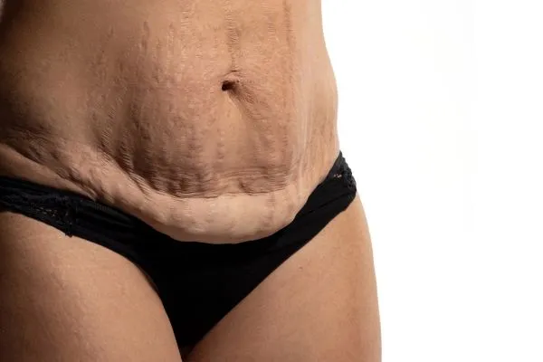 Image of womans stomach after weight loss injections Islington showing saggy skin