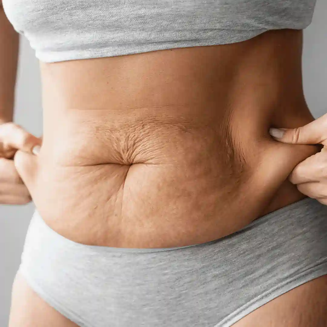Is It Normal to Have Loose Skin After Pregnancy Islington?