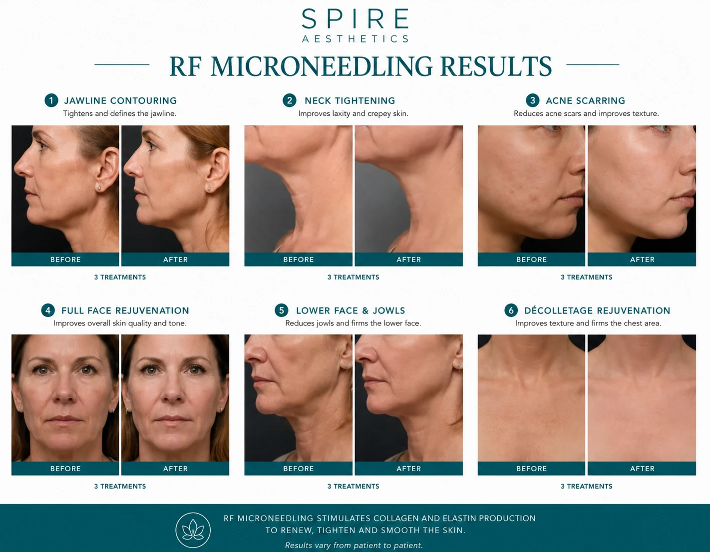 RF Microneedling Skin tightening Islington results