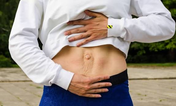 When Could Diastasis Recti Be the Missing Piece of the Puzzle Islington?