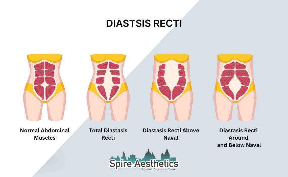 Is Non-Surgical Diastasis Recti Treatment Right for You? Common Concerns Answered Islington